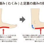 浮腫みと足の痛みの関係